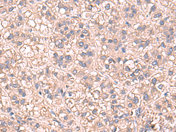 Immunohistochemistry of paraffin-embedded Human liver cancer tissue  using SARS Polyclonal Antibody at dilution of 1:60(×200)
