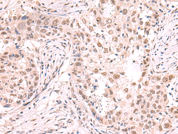 Immunohistochemistry of paraffin-embedded Human esophagus cancer tissue  using ZNF559 Polyclonal Antibody at dilution of 1:80(×200)