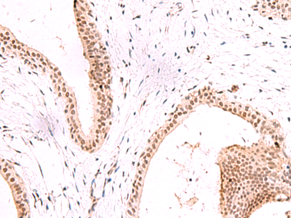 Immunohistochemistry of paraffin-embedded Human breast cancer tissue  using CBFA2T2 Polyclonal Antibody at dilution of 1:60(×200)