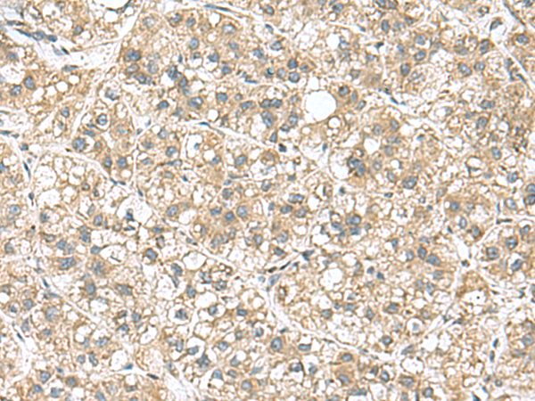 Immunohistochemistry of paraffin-embedded Human liver cancer tissue  using PAPSS2 Polyclonal Antibody at dilution of 1:95(×200)