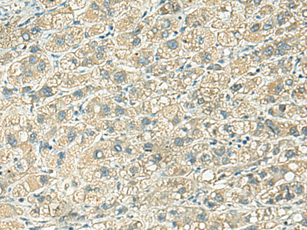 Immunohistochemistry of paraffin-embedded Human liver cancer tissue  using KLC2 Polyclonal Antibody at dilution of 1:100(×200)