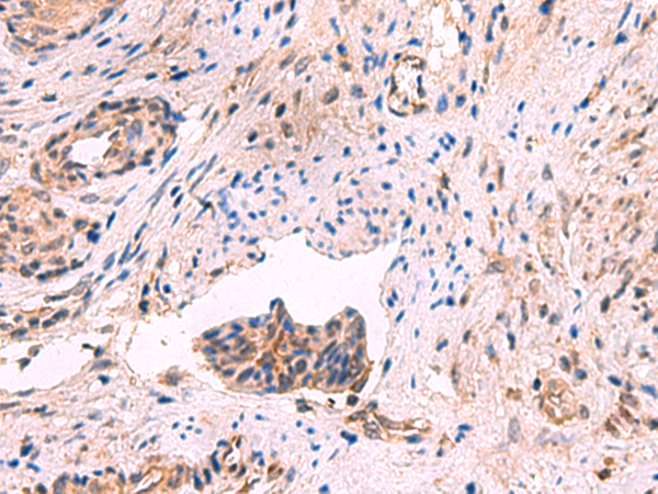 Immunohistochemistry of paraffin-embedded Human cervical cancer tissue  using GSPT2 Polyclonal Antibody at dilution of 1:50(×200)