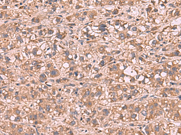 Immunohistochemistry of paraffin-embedded Human liver cancer tissue  using SHC4 Polyclonal Antibody at dilution of 1:90(×200)