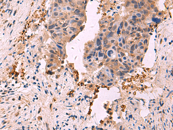 Immunohistochemistry of paraffin-embedded Human cervical cancer tissue  using SHC4 Polyclonal Antibody at dilution of 1:90(×200)