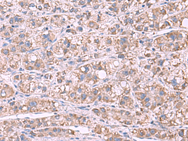 Immunohistochemistry of paraffin-embedded Human liver cancer tissue  using GSTCD Polyclonal Antibody at dilution of 1:70(×200)