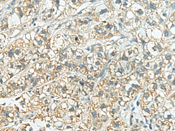 Immunohistochemistry of paraffin-embedded Human liver cancer tissue  using SORBS2 Polyclonal Antibody at dilution of 1:160(×200)