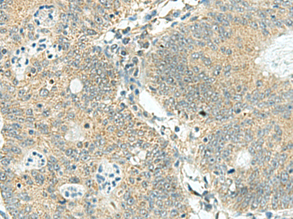 Immunohistochemistry of paraffin-embedded Human colorectal cancer tissue  using SORBS2 Polyclonal Antibody at dilution of 1:160(×200)