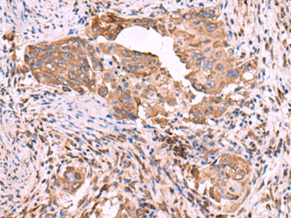 Immunohistochemistry of paraffin-embedded Human cervical cancer tissue  using EEF1D Polyclonal Antibody at dilution of 1:55(×200)