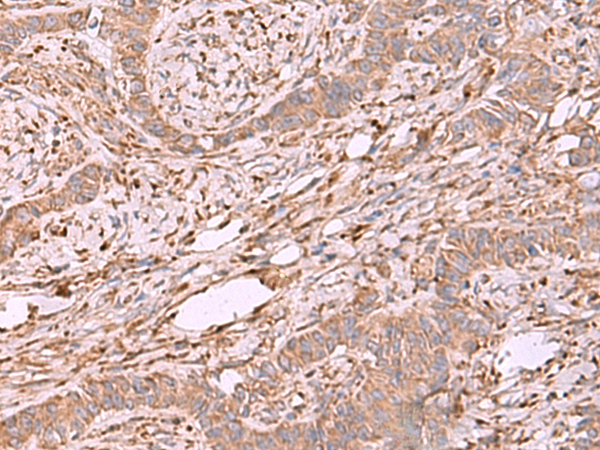 Immunohistochemistry of paraffin-embedded Human ovarian cancer tissue  using EEF1D Polyclonal Antibody at dilution of 1:55(×200)
