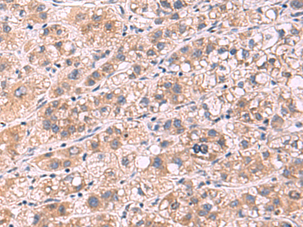 Immunohistochemistry of paraffin-embedded Human liver cancer tissue  using PPEF1 Polyclonal Antibody at dilution of 1:90(×200)