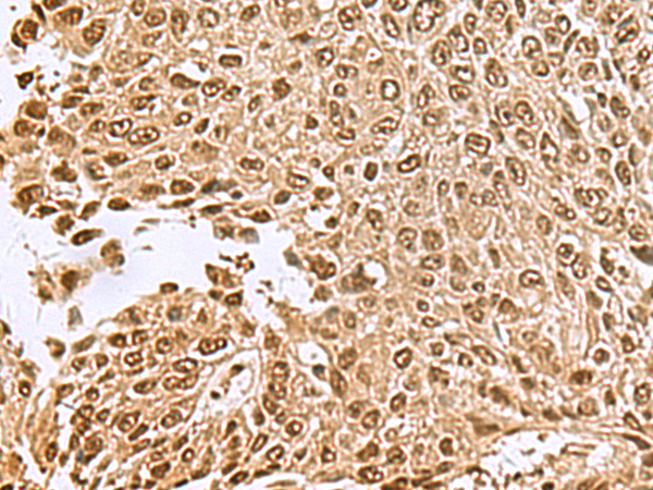 Immunohistochemistry of paraffin-embedded Human lung cancer tissue  using NVL Polyclonal Antibody at dilution of 1:70(×200)