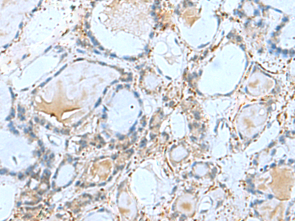 Immunohistochemistry of paraffin-embedded Human thyroid cancer tissue  using GPCPD1 Polyclonal Antibody at dilution of 1:50(×200)