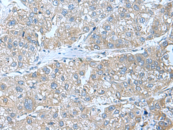 Immunohistochemistry of paraffin-embedded Human liver cancer tissue  using SRPK2 Polyclonal Antibody at dilution of 1:55(×200)