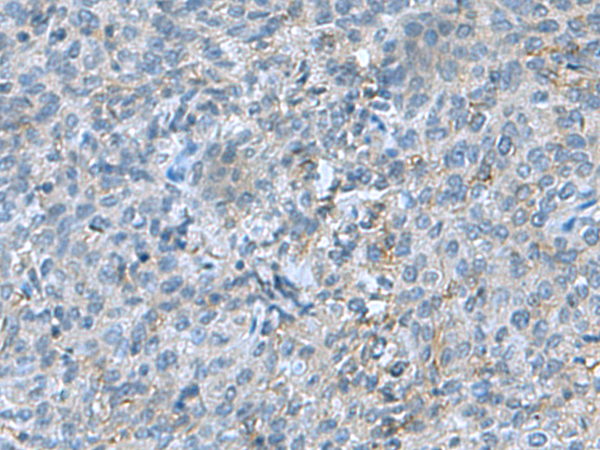 Immunohistochemistry of paraffin-embedded Human cervical cancer tissue  using SRPK2 Polyclonal Antibody at dilution of 1:55(×200)