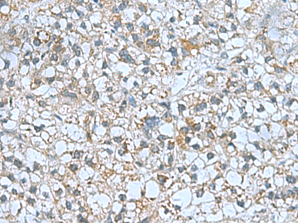 Immunohistochemistry of paraffin-embedded Human liver cancer tissue  using CNTN4 Polyclonal Antibody at dilution of 1:60(×200)