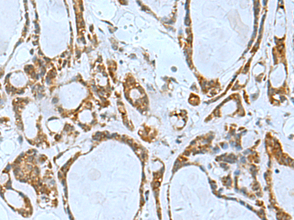 Immunohistochemistry of paraffin-embedded Human thyroid cancer tissue  using TSGA10 Polyclonal Antibody at dilution of 1:50(×200)