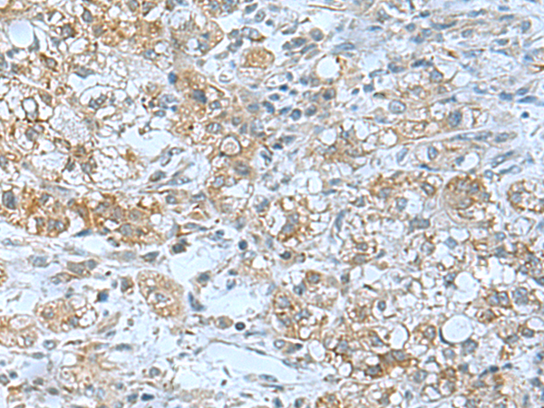 Immunohistochemistry of paraffin-embedded Human liver cancer tissue  using TSGA10 Polyclonal Antibody at dilution of 1:50(×200)