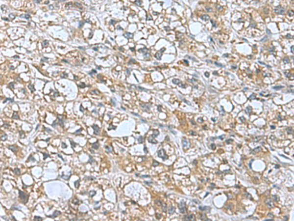 Immunohistochemistry of paraffin-embedded Human liver cancer tissue  using KANSL1L Polyclonal Antibody at dilution of 1:55(×200)