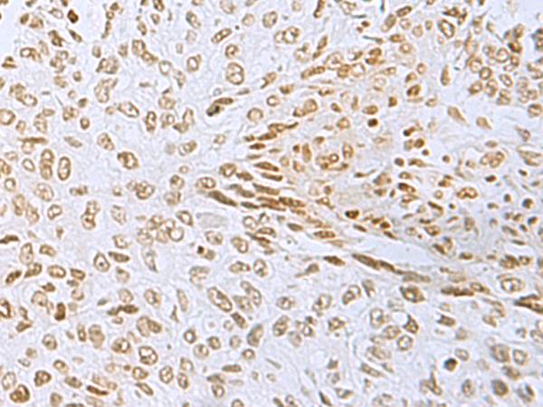 Immunohistochemistry of paraffin-embedded Human lung cancer tissue  using L3MBTL2 Polyclonal Antibody at dilution of 1:60(×200)