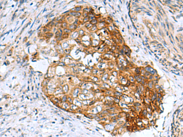 Immunohistochemistry of paraffin-embedded Human cervical cancer tissue  using AP1S3 Polyclonal Antibody at dilution of 1:55(×200)