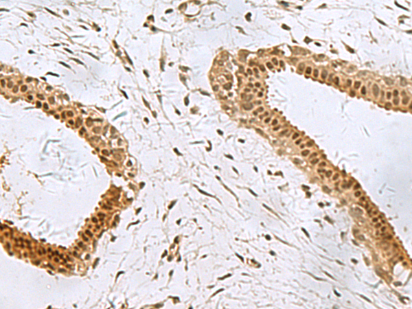 Immunohistochemistry of paraffin-embedded Human breast cancer tissue  using PCBD1 Polyclonal Antibody at dilution of 1:90(×200)