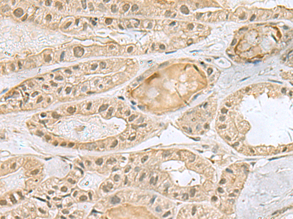 Immunohistochemistry of paraffin-embedded Human thyroid cancer tissue  using PCBD1 Polyclonal Antibody at dilution of 1:90(×200)