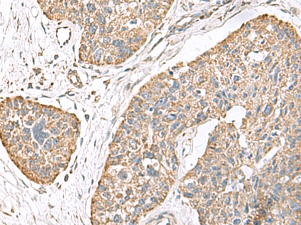 Immunohistochemistry of paraffin-embedded Human esophagus cancer tissue  using TMEM141 Polyclonal Antibody at dilution of 1:70(×200)