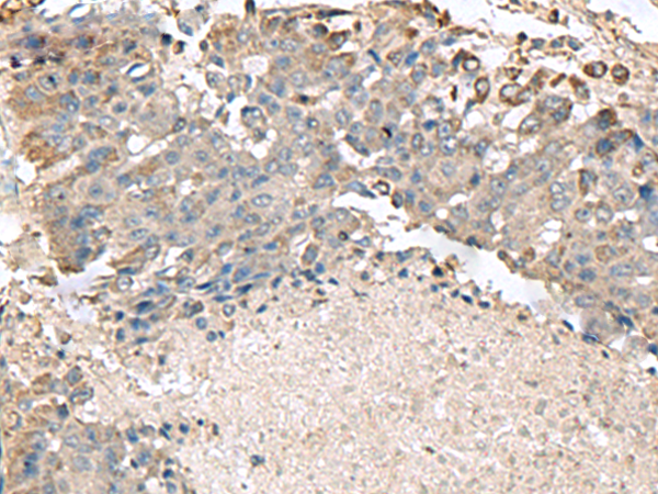 Immunohistochemistry of paraffin-embedded Human liver cancer tissue  using TMEM141 Polyclonal Antibody at dilution of 1:70(×200)