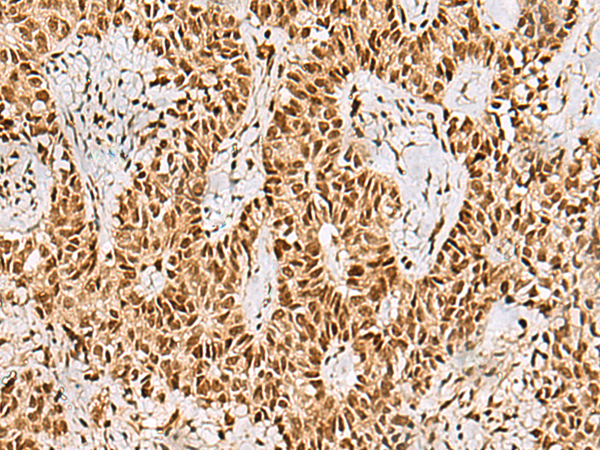 Immunohistochemistry of paraffin-embedded Human ovarian cancer tissue  using PHF5A Polyclonal Antibody at dilution of 1:55(×200)