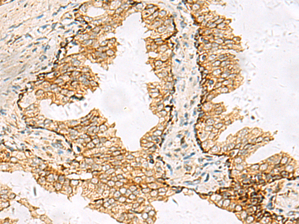 Immunohistochemistry of paraffin-embedded Human prost at e cancer tissue  using SH3YL1 Polyclonal Antibody at dilution of 1:55(×200)