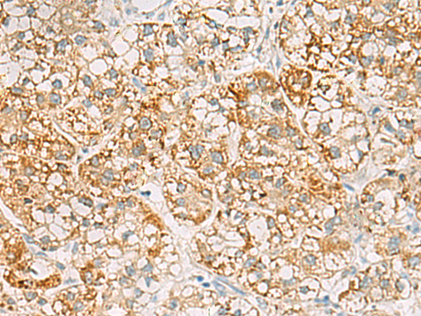 Immunohistochemistry of paraffin-embedded Human liver cancer tissue  using SH3YL1 Polyclonal Antibody at dilution of 1:55(×200)