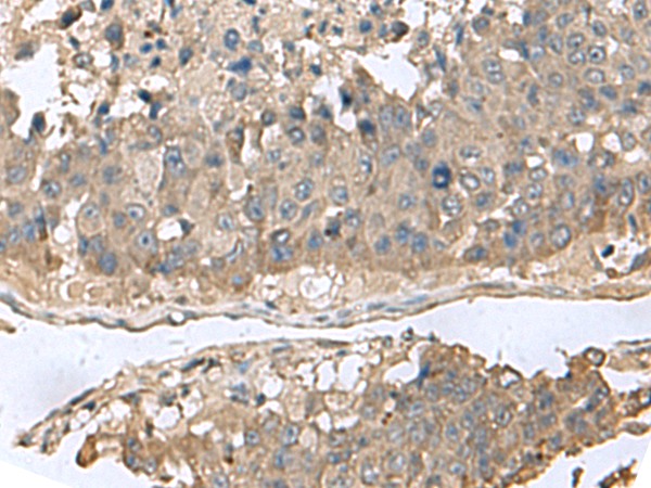 Immunohistochemistry of paraffin-embedded Human liver cancer tissue  using GABARAPL2 Polyclonal Antibody at dilution of 1:60(×200)
