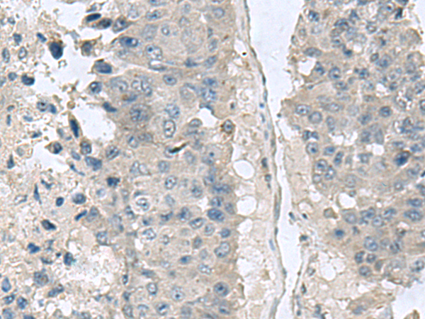 Immunohistochemistry of paraffin-embedded Human liver cancer tissue  using NPHP1 Polyclonal Antibody at dilution of 1:60(×200)