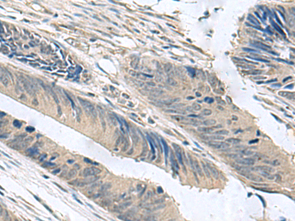 Immunohistochemistry of paraffin-embedded Human colorectal cancer tissue  using NPHP1 Polyclonal Antibody at dilution of 1:60(×200)