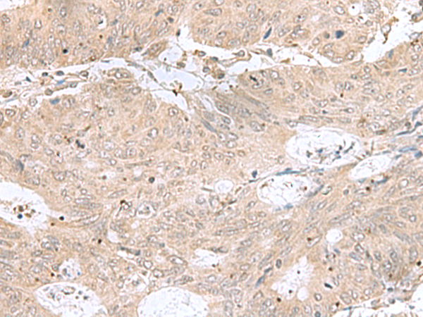 Immunohistochemistry of paraffin-embedded Human colorectal cancer tissue  using RPL35 Polyclonal Antibody at dilution of 1:50(×200)