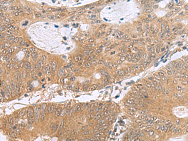 Immunohistochemistry of paraffin-embedded Human colorectal cancer tissue  using PHPT1 Polyclonal Antibody at dilution of 1:170(×200)