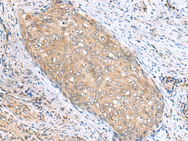 Immunohistochemistry of paraffin-embedded Human cervical cancer tissue  using PHPT1 Polyclonal Antibody at dilution of 1:170(×200)