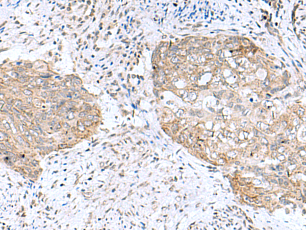 Immunohistochemistry of paraffin-embedded Human cervical cancer tissue  using PAM16 Polyclonal Antibody at dilution of 1:50(×200)