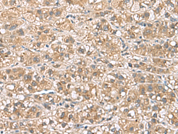 Immunohistochemistry of paraffin-embedded Human liver cancer tissue  using PHLDA3 Polyclonal Antibody at dilution of 1:110(×200)