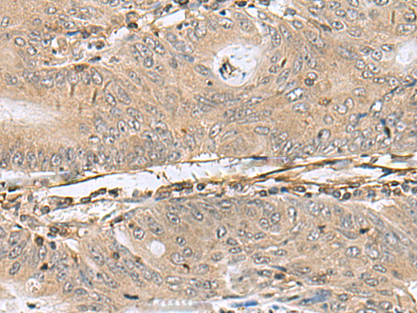 Immunohistochemistry of paraffin-embedded Human colorectal cancer tissue  using PTPRS Polyclonal Antibody at dilution of 1:110(×200)