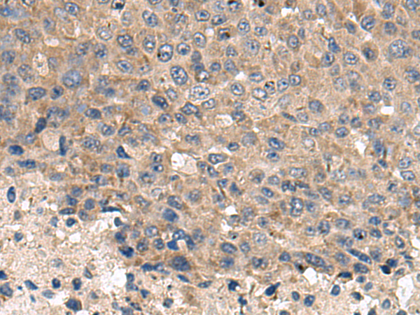 Immunohistochemistry of paraffin-embedded Human liver cancer tissue  using CD59 Polyclonal Antibody at dilution of 1:120(×200)