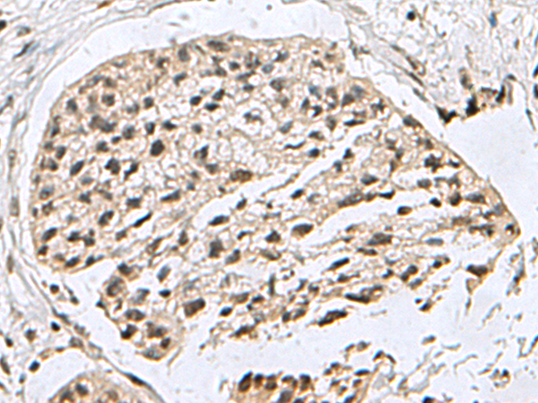 Immunohistochemistry of paraffin-embedded Human esophagus cancer tissue  using H2AFJ Polyclonal Antibody at dilution of 1:160(×200)