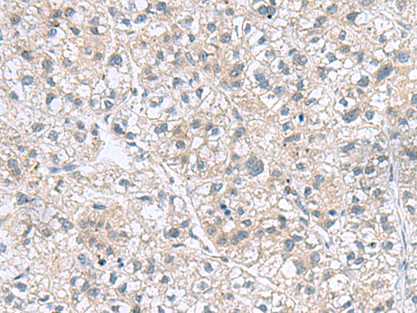 Immunohistochemistry of paraffin-embedded Human liver cancer tissue  using GEMIN7 Polyclonal Antibody at dilution of 1:70(×200)