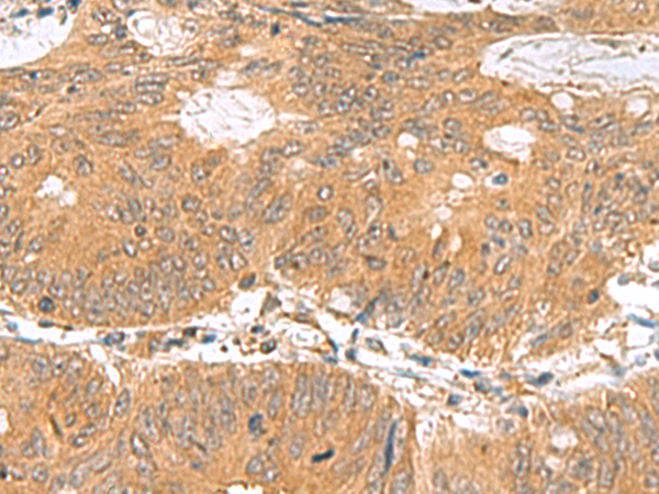 Immunohistochemistry of paraffin-embedded Human colorectal cancer tissue  using GEMIN7 Polyclonal Antibody at dilution of 1:70(×200)