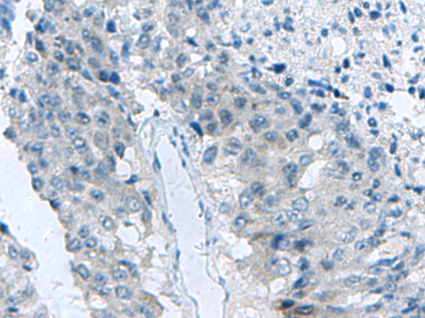 Immunohistochemistry of paraffin-embedded Human liver cancer tissue  using MED31 Polyclonal Antibody at dilution of 1:140(×200)