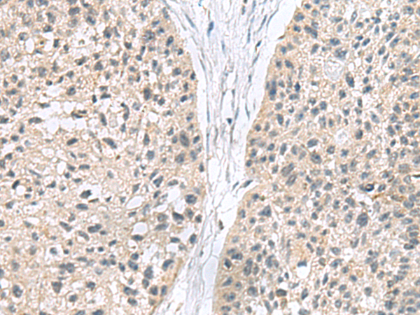 Immunohistochemistry of paraffin-embedded Human esophagus cancer tissue  using MIA Polyclonal Antibody at dilution of 1:180(×200)