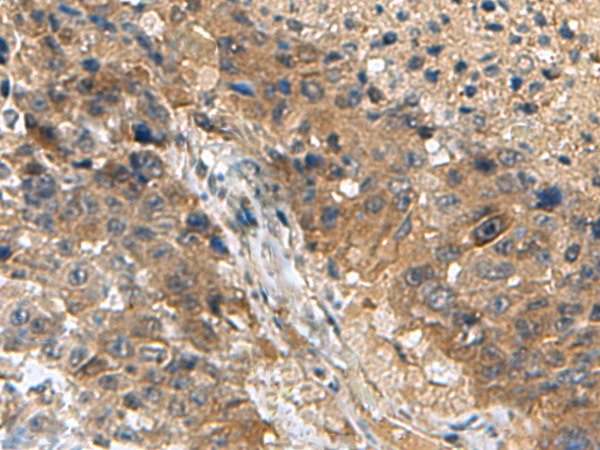 Immunohistochemistry of paraffin-embedded Human liver cancer tissue  using TPD52L3 Polyclonal Antibody at dilution of 1:140(×200)