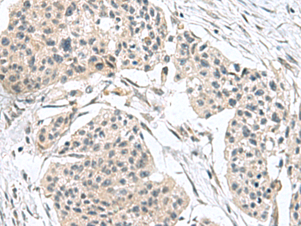 Immunohistochemistry of paraffin-embedded Human esophagus cancer tissue  using TPD52L3 Polyclonal Antibody at dilution of 1:140(×200)