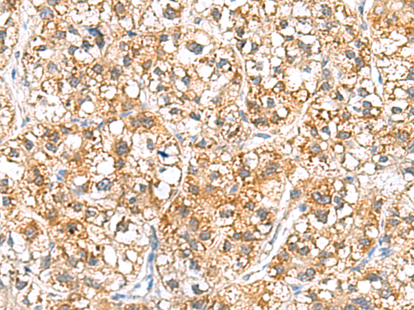 Immunohistochemistry of paraffin-embedded Human liver cancer tissue  using RIDA Polyclonal Antibody at dilution of 1:70(×200)