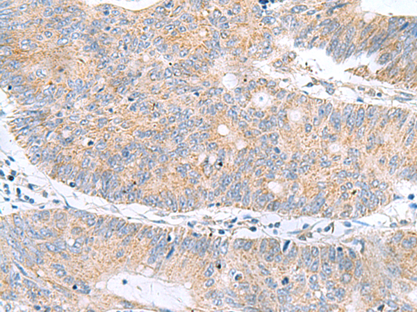 Immunohistochemistry of paraffin-embedded Human colorectal cancer tissue  using RIDA Polyclonal Antibody at dilution of 1:70(×200)
